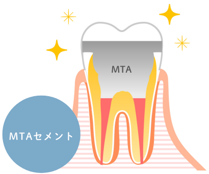 歯の神経を守り、再発を防ぐ「歯髄温存療法」