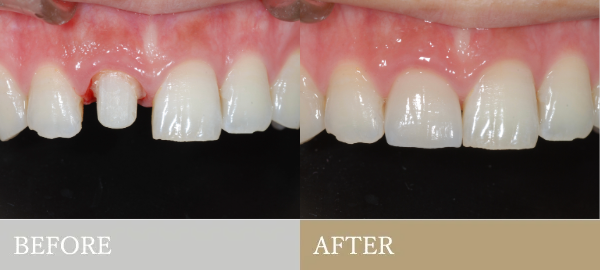 BEFORE AFTER