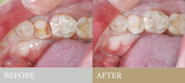 BEFORE AFTER